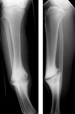 Bone Fracture Healing | Orthoped