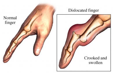 Dislocated Finger Symptoms