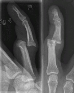 Finger Dislocation X-ray