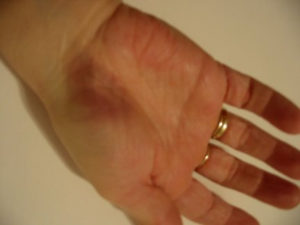 hand bruise or a contusion