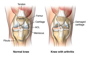 Anterior view of knee joint comparing normal vs. damaged cartilage; AMuscsk_20140311_v0_001; SOURCE: ortho_tot-knee-repla-arth_anat.ai