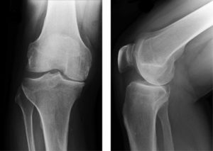 X-ray picture of a medial osteoarthritis of the knee joint.