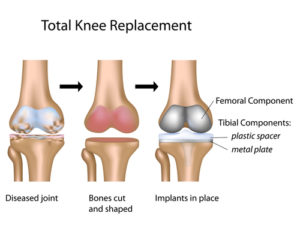 total knee replacement operation