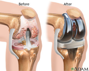 Tricompartmental total knee prosthesis