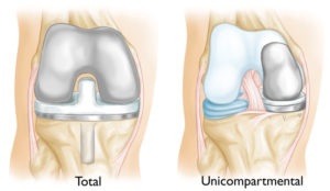 Unicompartmental and tricompartmental knee prosthesis